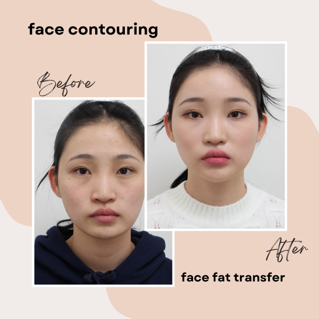 Asian girl before and after face fat transfer. Left side face has asymmetry, looks uneven, but right side looks very smooth and even more contouring.