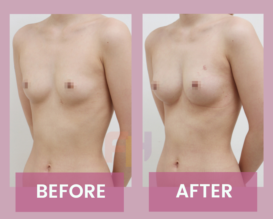 breast fat transfer pictures before and after. On the left corner - there's woman upper body picture with small breast, on the right corner - there's there's woman upper body picture with enlarged breast