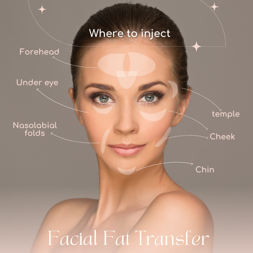 European woman face with marks for facial fat transfer areas for treatment : temple, forehead, under eye, nasolabial folds, chin, cheeks