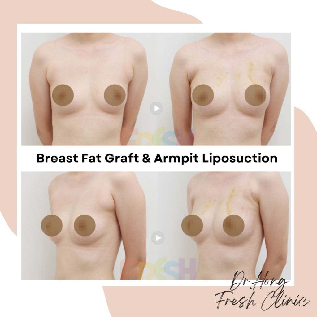 breast fat transfer & armpit liposuction in Fresh Clinic before and after photo : there are 2 woman upper body pictures on the top, showing front view of breast and underarms condition before treatment and after. Same things on the bottom, but showing 45 degree view . 