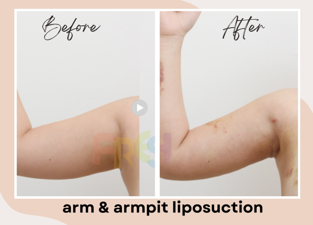 upper arm liposuction before & after photo of one woman. There are 2 photo of right arm - one on the left on the scree is bulky and fat, other one on the right of the screen is slimmer one after liposuction