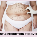 belly fat was designed by name pan for liposuction surgery by Dr.Hong from Fresh Clinic
