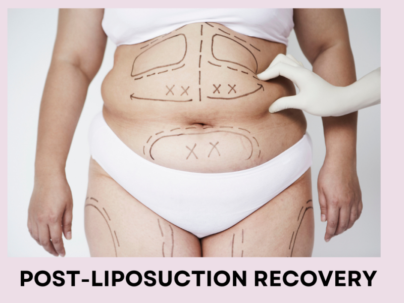 belly fat was designed by name pan for liposuction surgery by Dr.Hong from Fresh Clinic